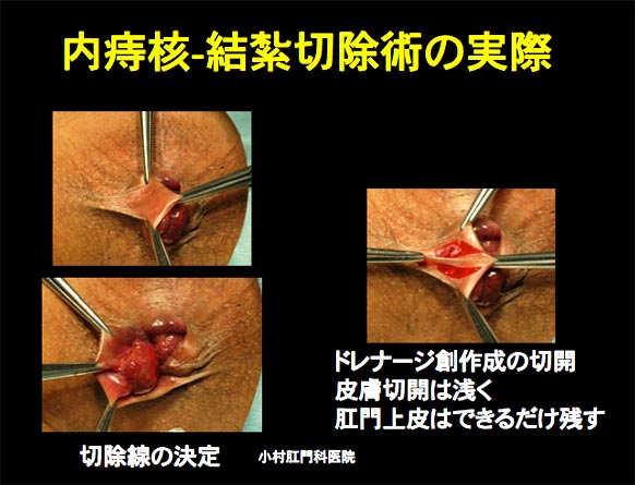 注射 術 後 ジオン